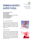 Enfermedad Acido-Péptica (gastritis y úlceras)